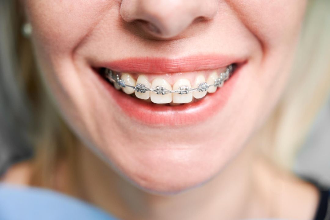 straight teeth with dental braces